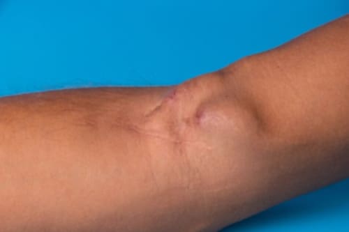 Protocolo de fistula arterio venosa.